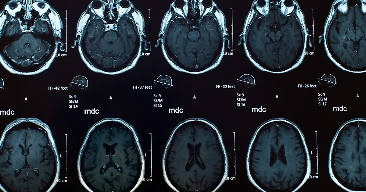 Brain X-Ray